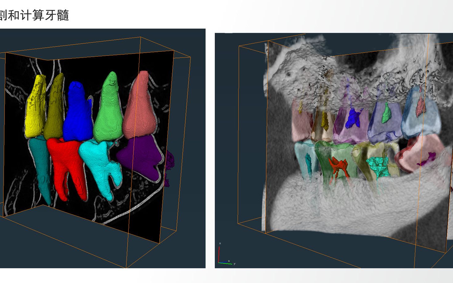 【Avizo/Amira Demo】基于CBCT图像做牙齿分割 (分水岭)哔哩哔哩bilibili