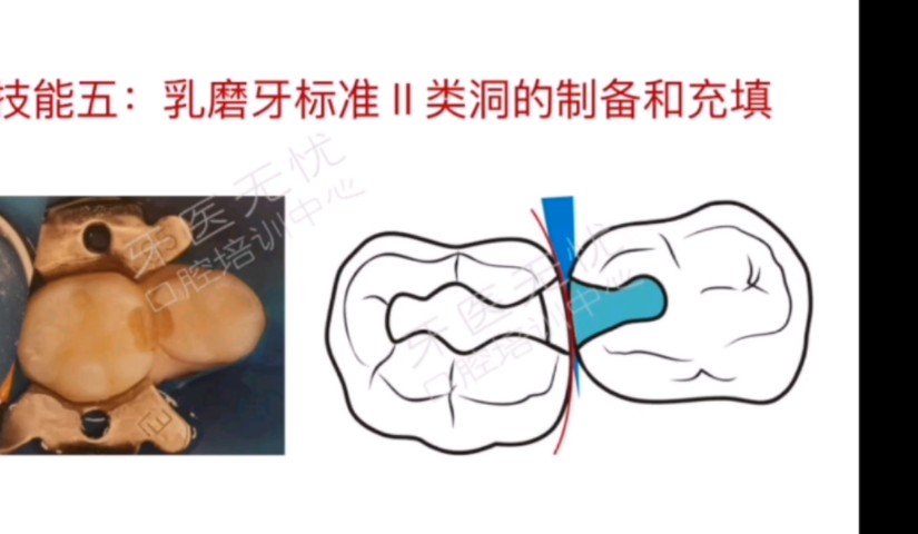 乳磨牙标准二类洞的制备和充填