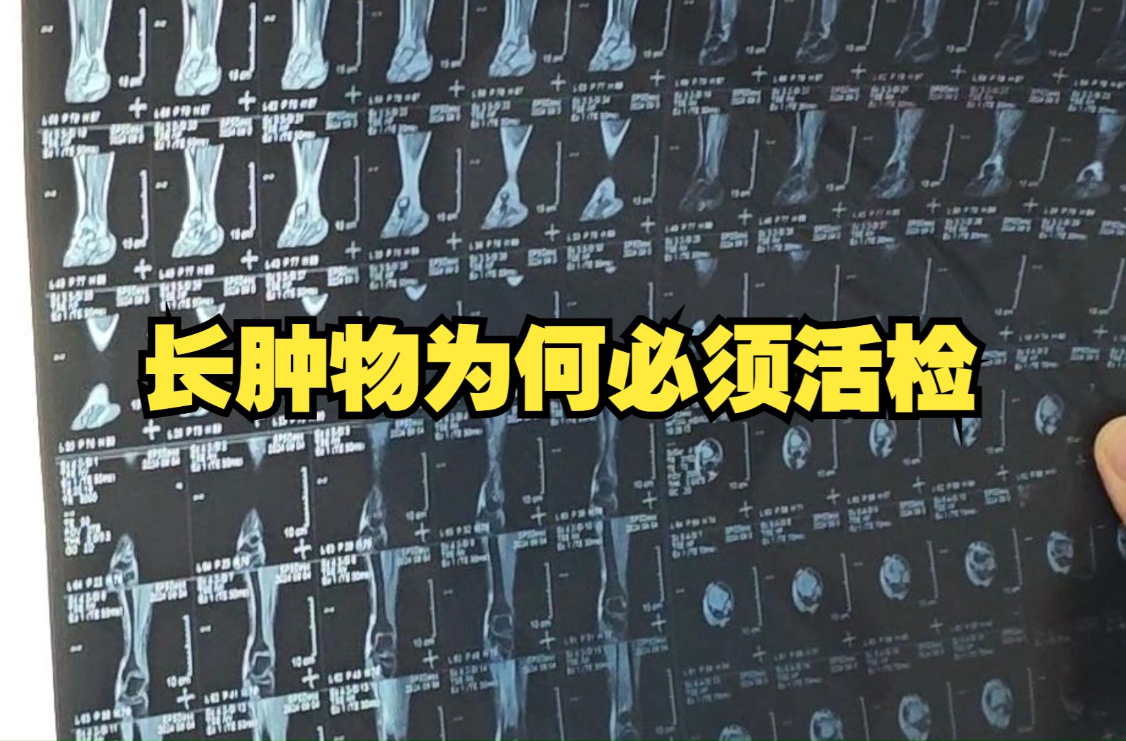 长肿物,为什么要先活检再手术?什么叫非计划手术?哔哩哔哩bilibili