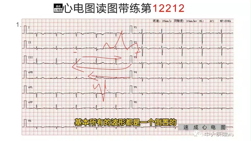 镜像右位心
