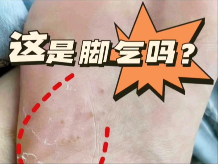 最近得了脚气,让我很是苦恼,朋友们怎么办?