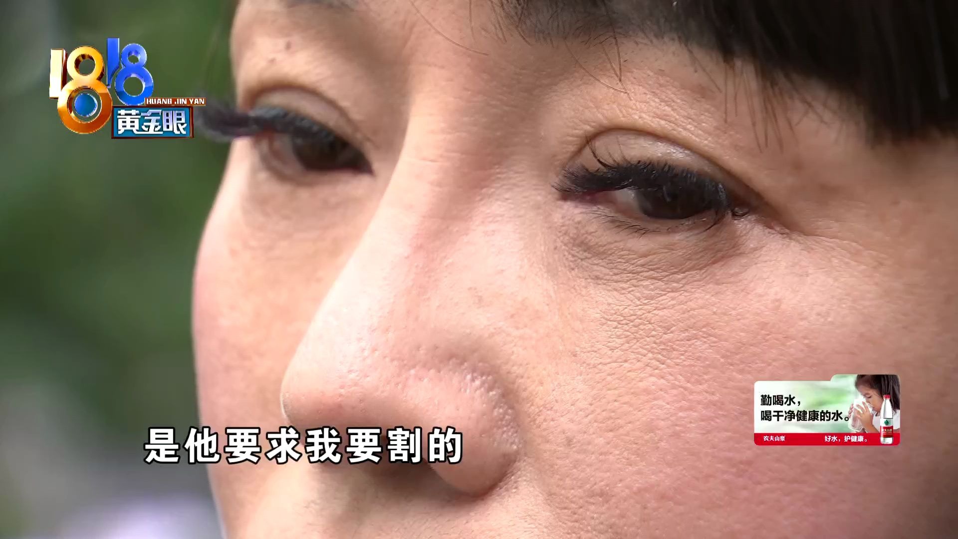 1818黄金眼美莱医院手术后眼睛难看鼻子歪