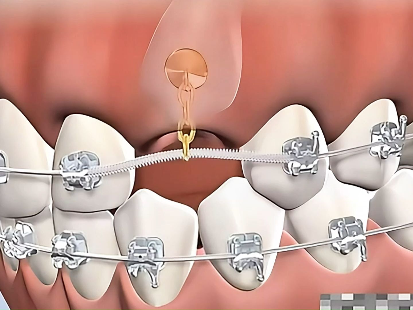 北京牙齿矫正:牙齿先天未萌出,金属牙套牵引拉出来!