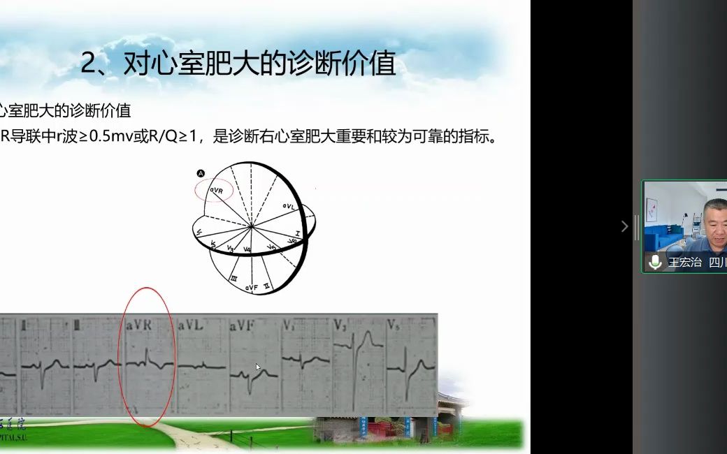 不可忽视的aVR导联哔哩哔哩bilibili