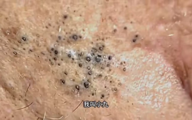密密麻麻的黑头.