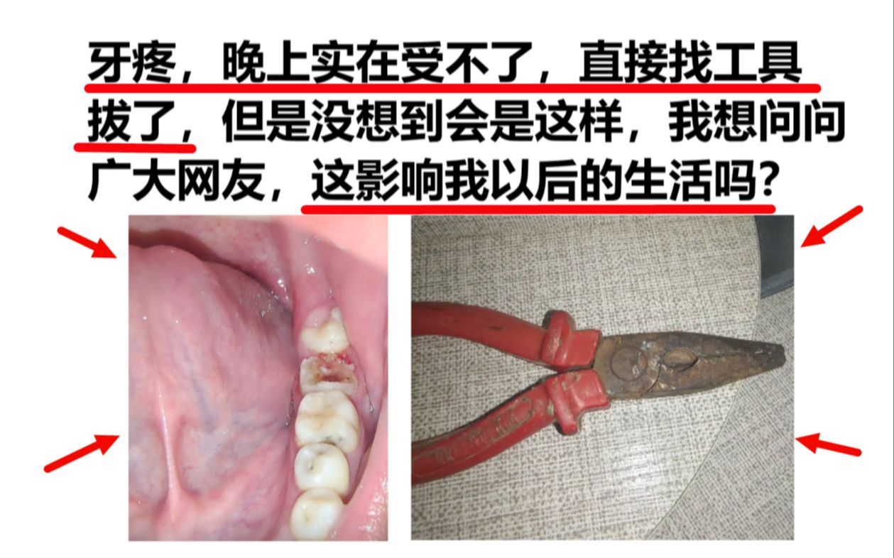 牙痛的实在受不了,于是找工具拔了,没想到成这样了,会影响以后吗?哔哩哔哩bilibili