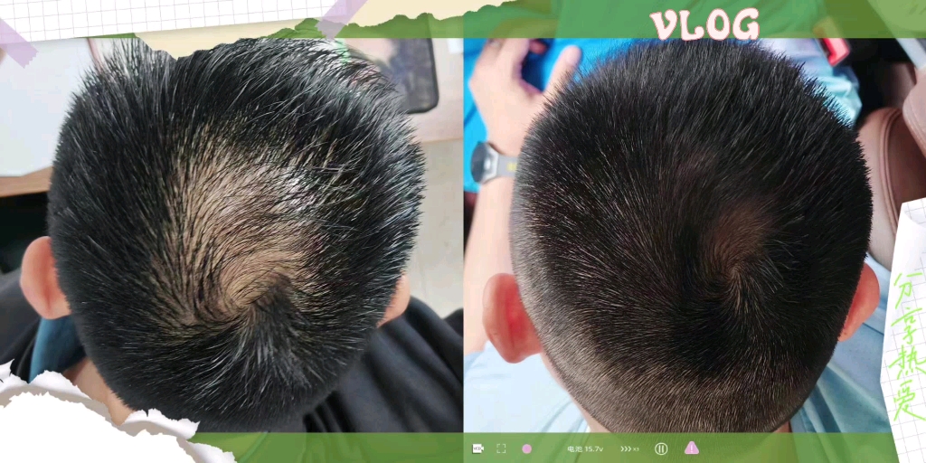 以前走哪头顶都是一道反光,走过很多弯路总算好了,能长起来就行,还是