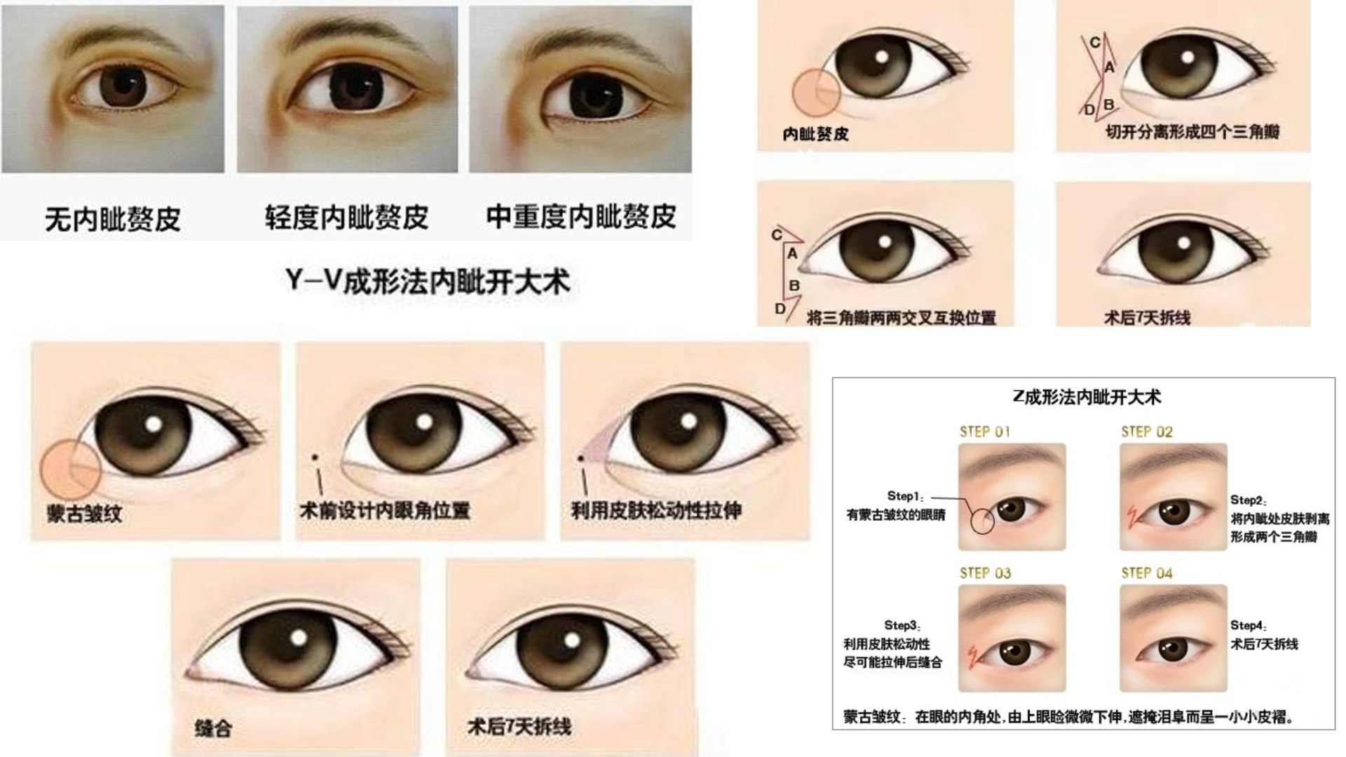 开眼角手术 内眦赘皮矫正术