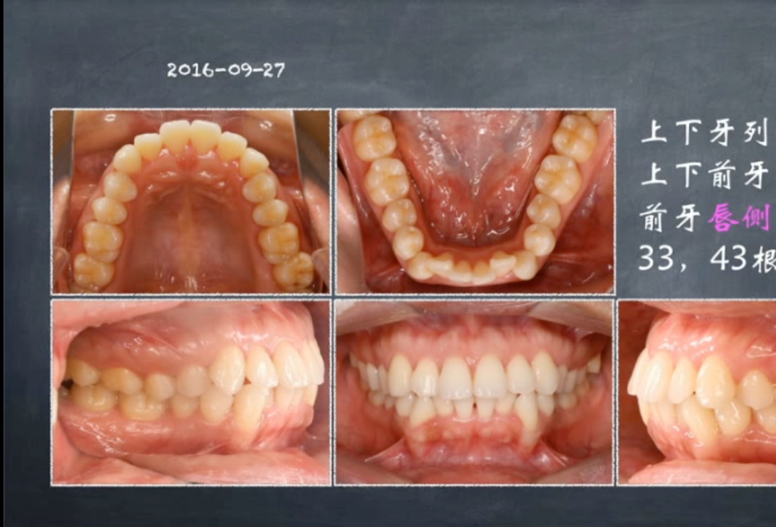 正畸学基础《不同托槽的特征及选择》——杨勇爱丁堡皇家外科学院