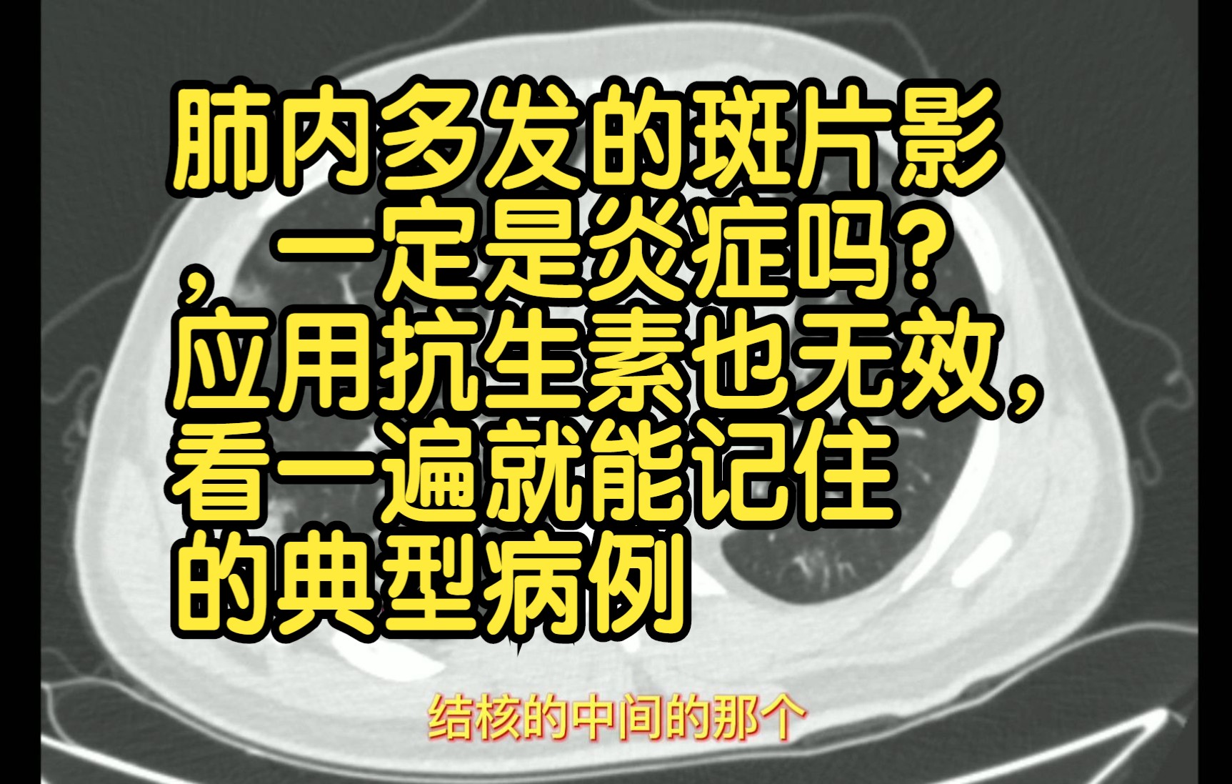 肺内多发的斑片影,一定是炎症吗?应用抗生素也无效,怎么回事?看一遍就能记住的典型病例哔哩哔哩bilibili