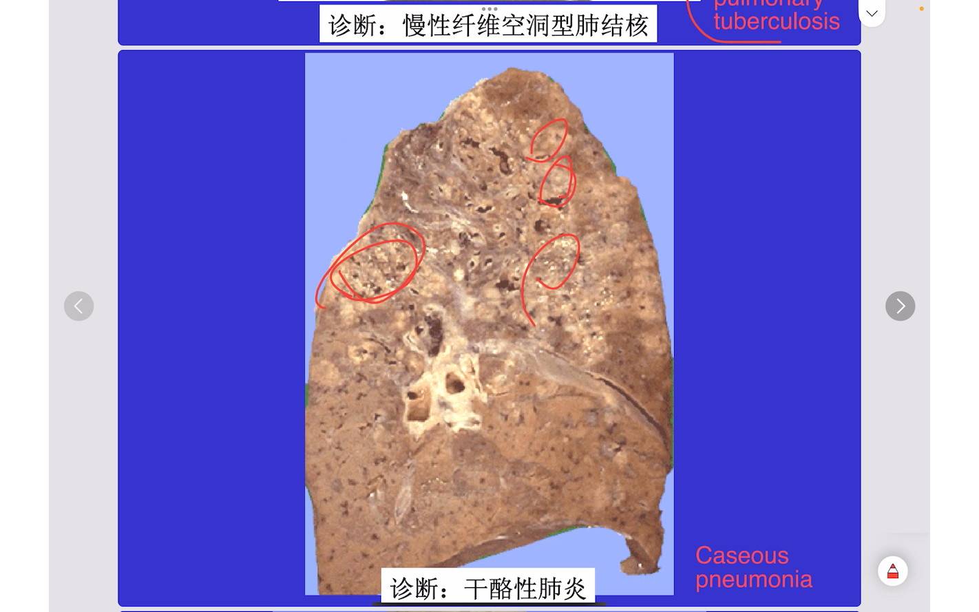 慢性纤维空洞型肺结核图片