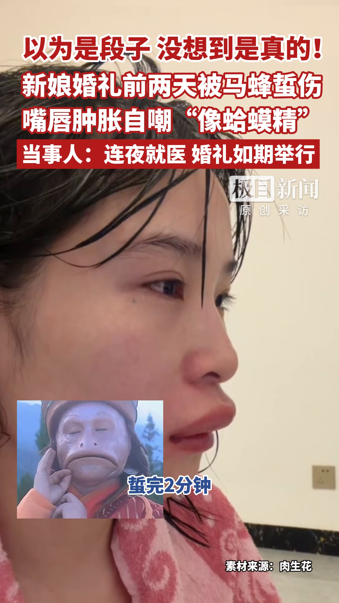 以为是段子，没想到是真的！新娘婚礼前两天被马蜂蜇伤，嘴唇肿胀自嘲“像蛤蟆精”，当事人：连夜就医，婚礼如期举行