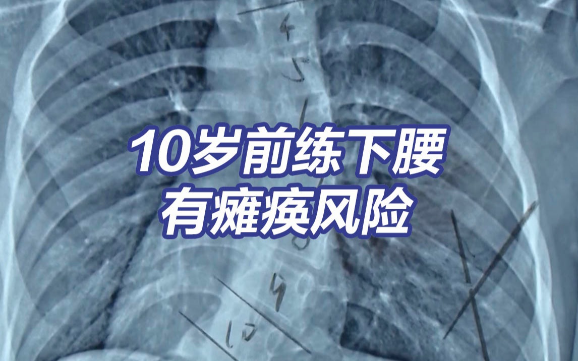 暑期“下腰瘫”增多!专家提醒10岁前练下腰有瘫痪风险哔哩哔哩bilibili