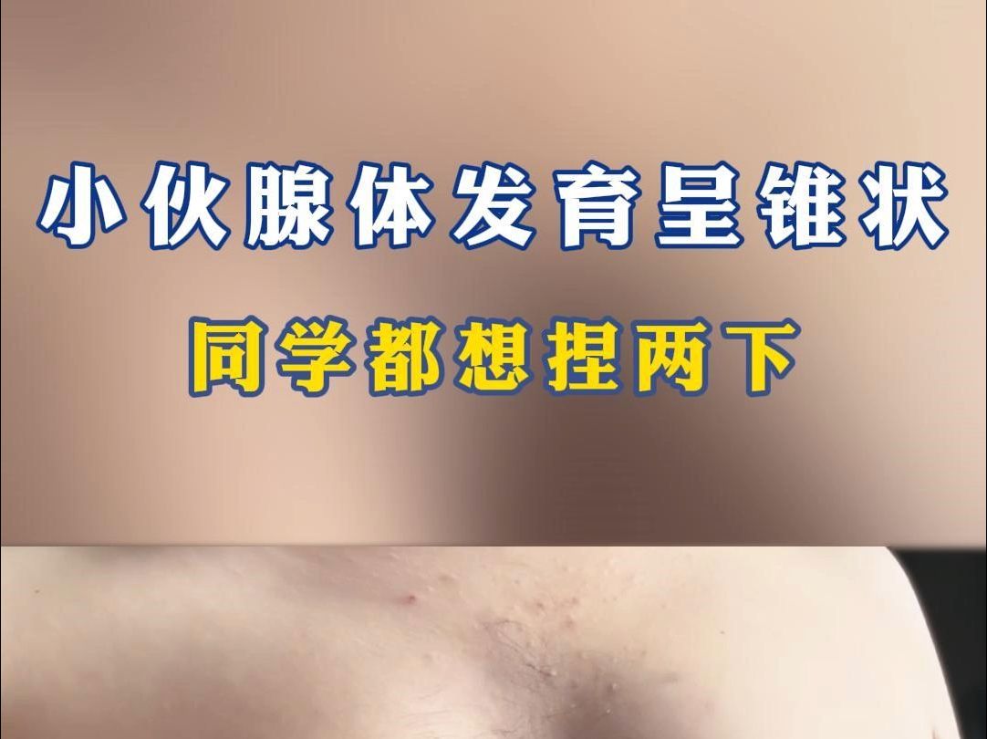 小伙腺体发育呈锥状,同学都想捏两下哔哩哔哩bilibili