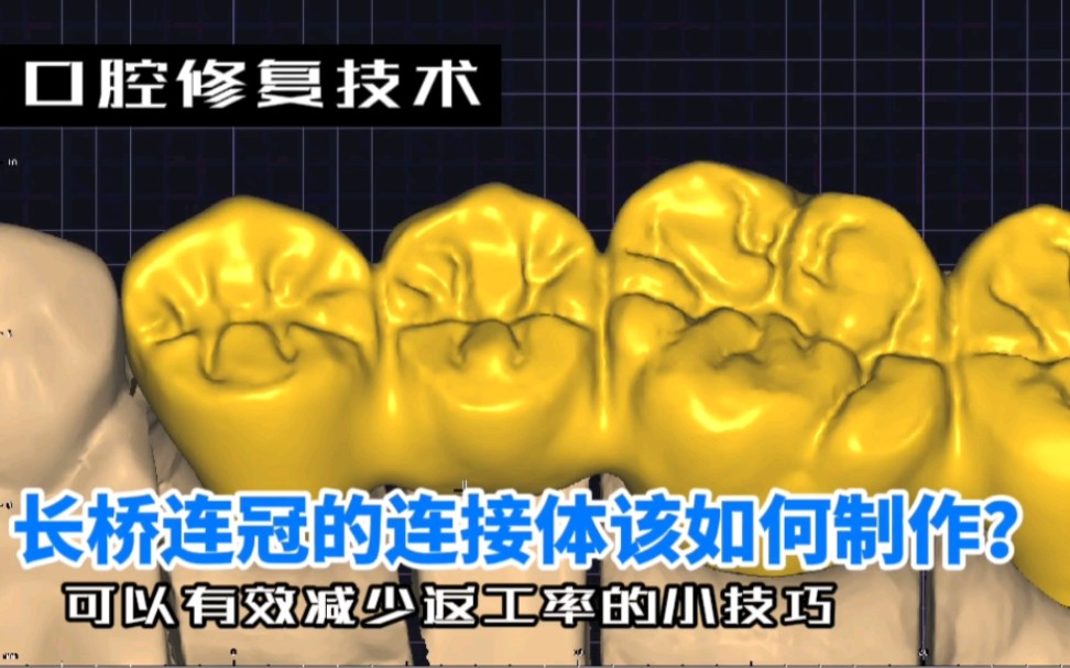 [图]［口腔修复技术］能够减少连冠长桥断裂返工的连接体设计技巧