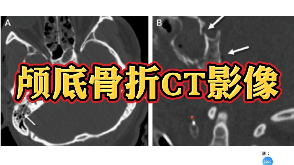 颅底骨折典型CT病例分享,仔细观察必不可少!哔哩哔哩bilibili