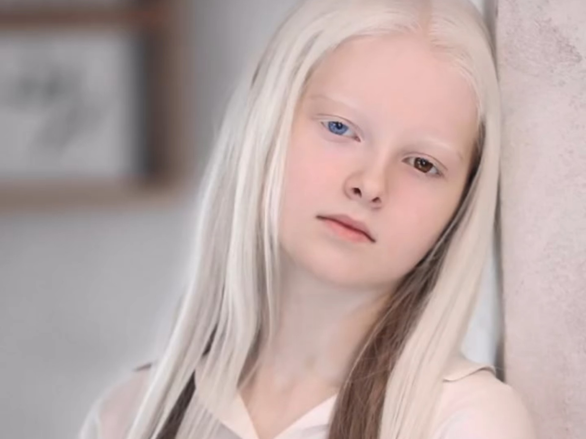 埃彭迪耶娃因基因缺陷疾病:白化病和罕见双瞳异色症走红车臣共和国和