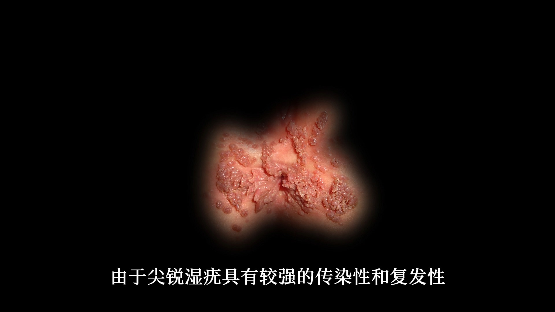 大范围尖锐湿疣症状图片