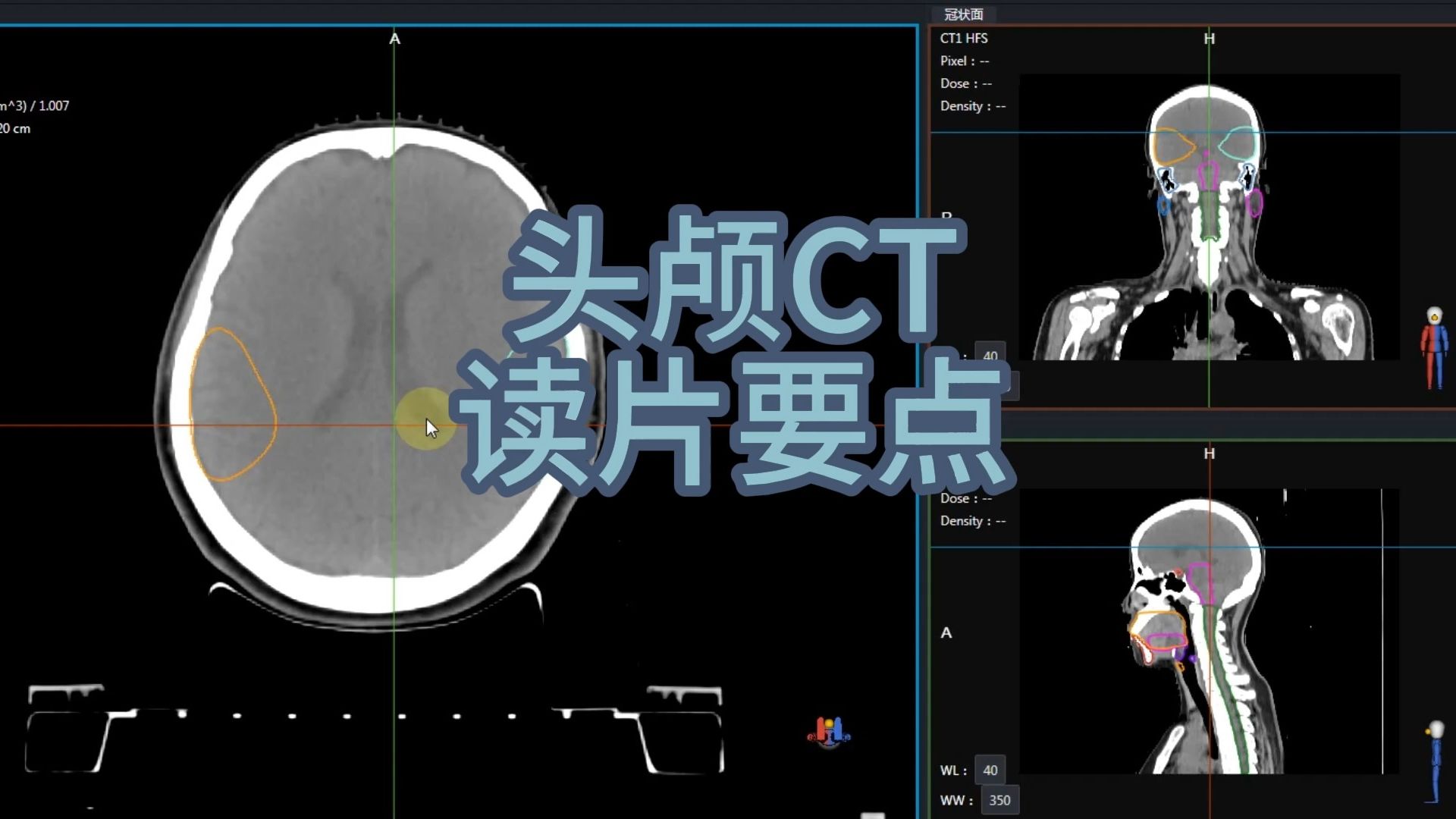 头颅CT读片要点哔哩哔哩bilibili