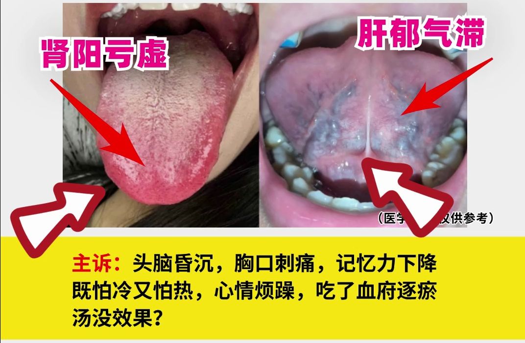【注意】舌下血管粗紫,感觉都快要爆开了!