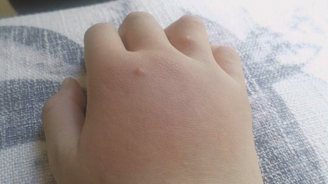 被蠓咬成猪手广东人的日常