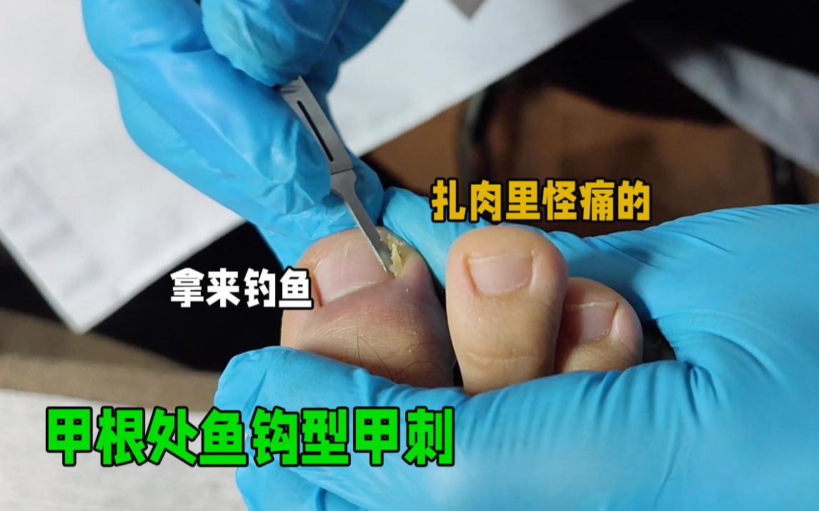 甲根处修出超大甲刺,鱼钩倒刺可以拿来钓鱼了