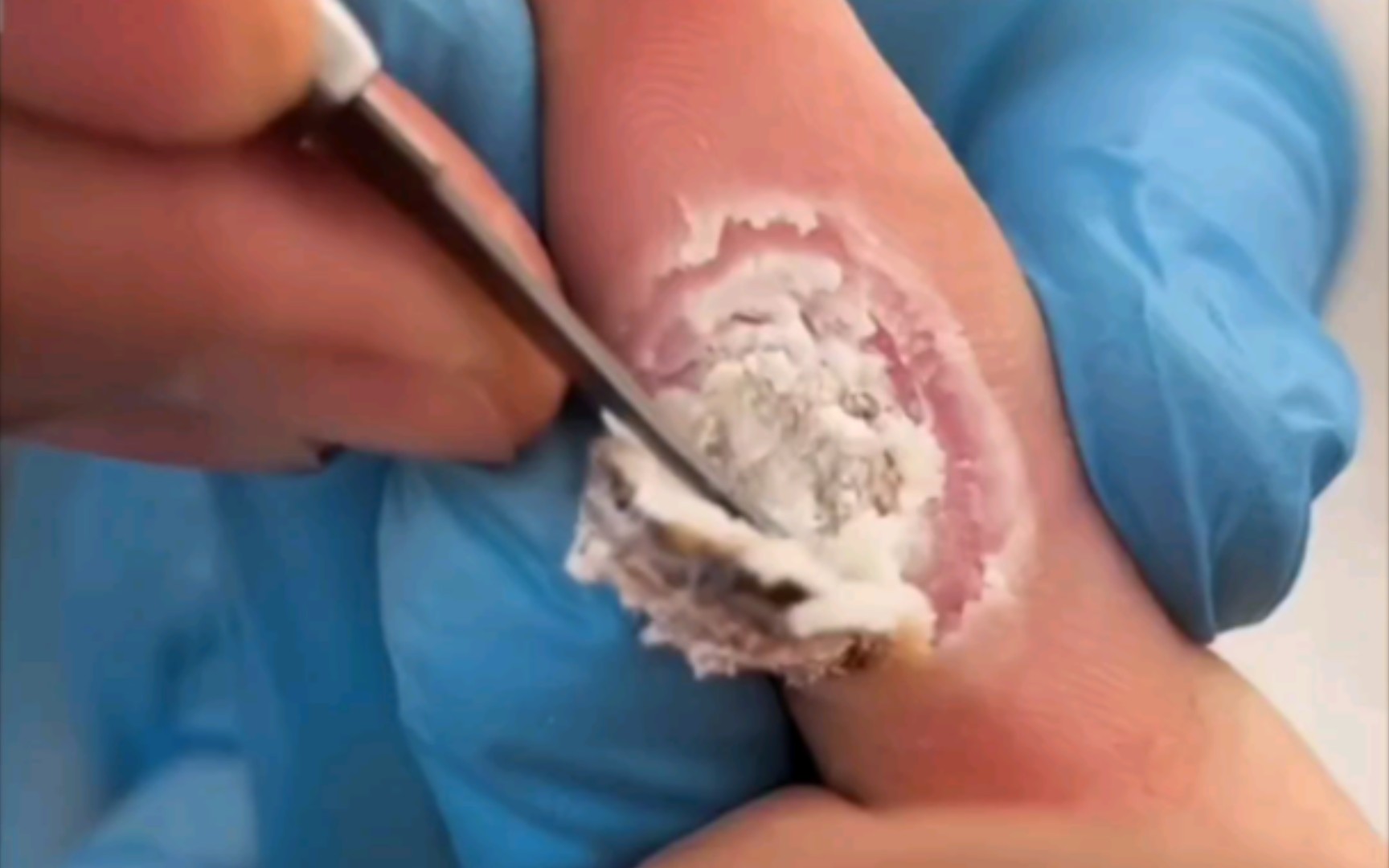 手指大拇指,超大跖疣!这是扣了不该扣的东西,把手传染了