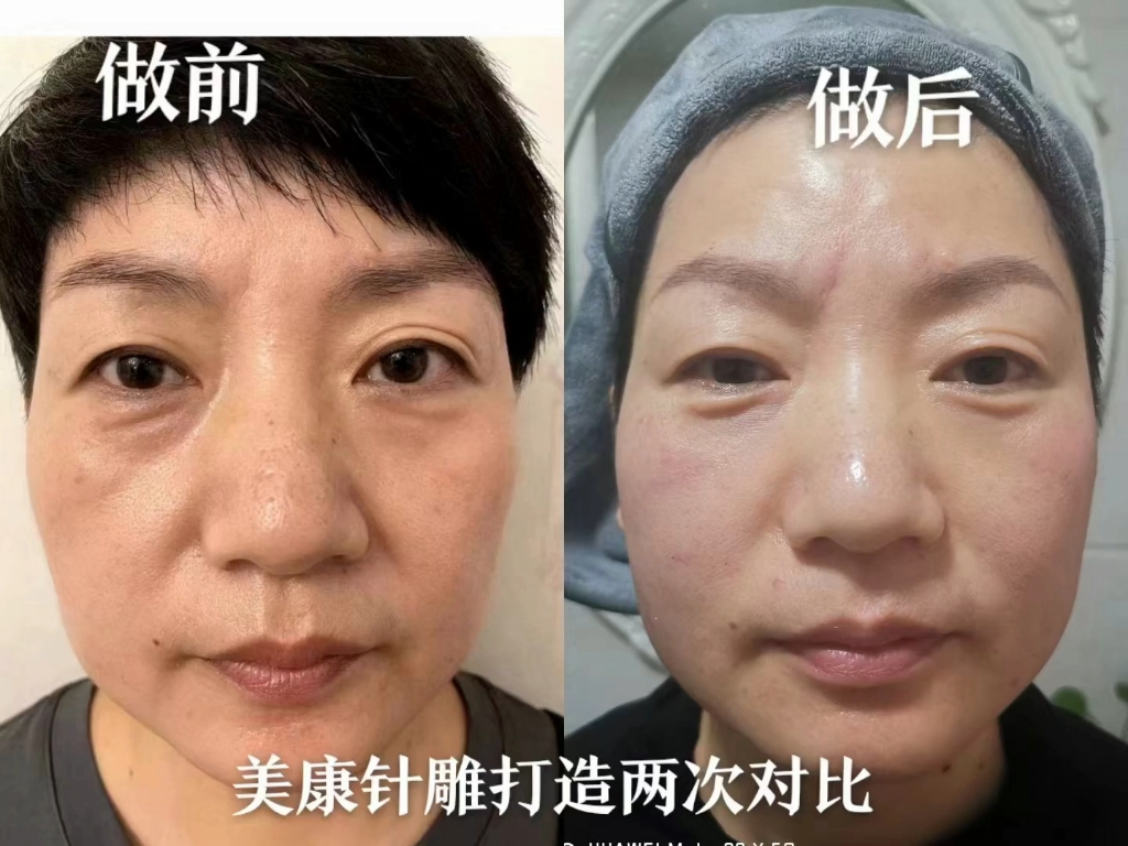 美康针灸美雕效果才是根本