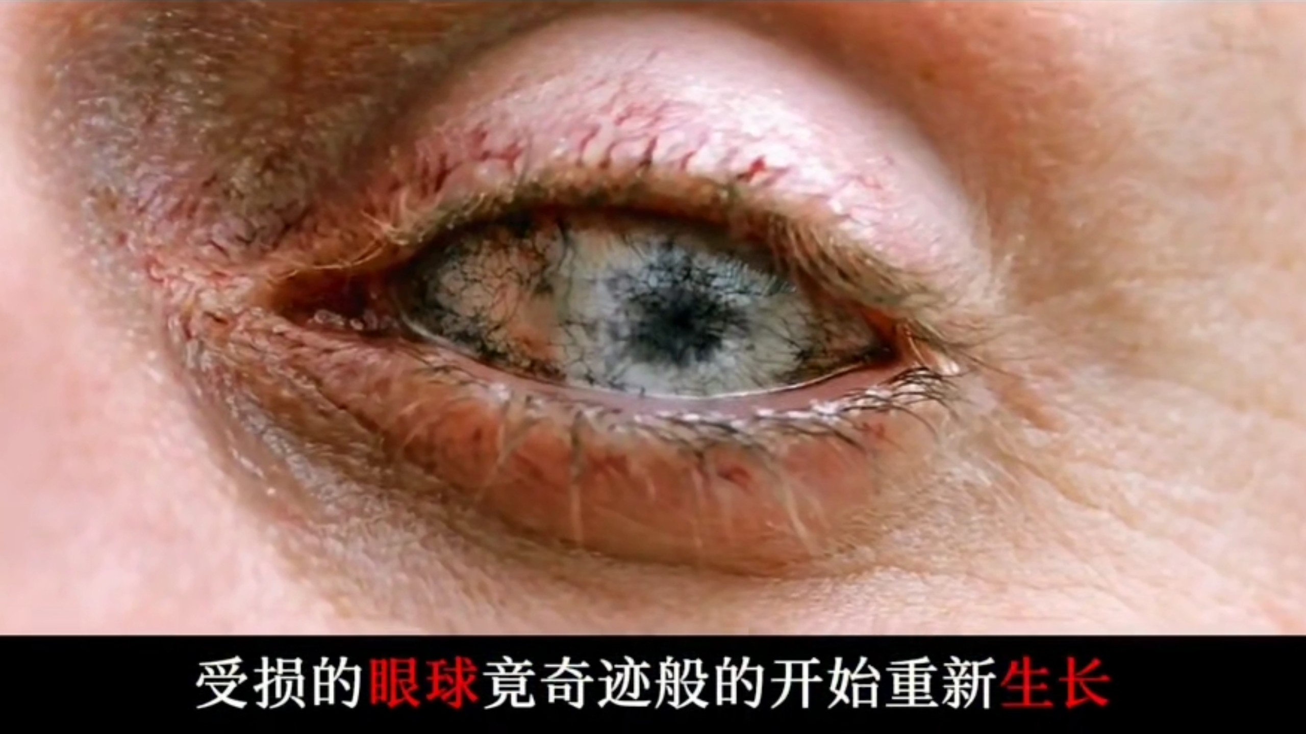 男人瞎了30多年，今天终于在纳米技术的治疗下，受损的眼球竟奇迹般的开始重新生长