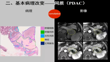 海军军医大学附属长海医院 陆建平胰腺基本病变:影像与病理哔哩哔哩bilibili