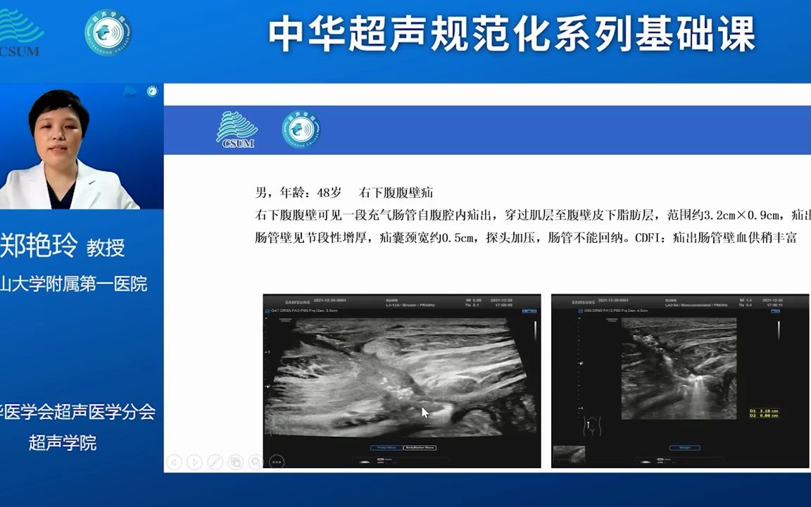 搬运 腹壁和腹腔疾病的诊断和鉴别诊断郑艳玲哔哩哔哩bilibili