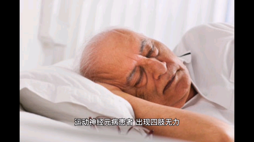 运动神经元病四肢无力蹲下站立困难