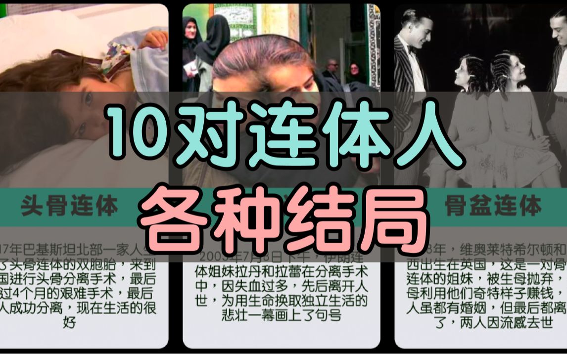 [图]10对连体人的各种结局，有人生活圆满，有人代价凄惨