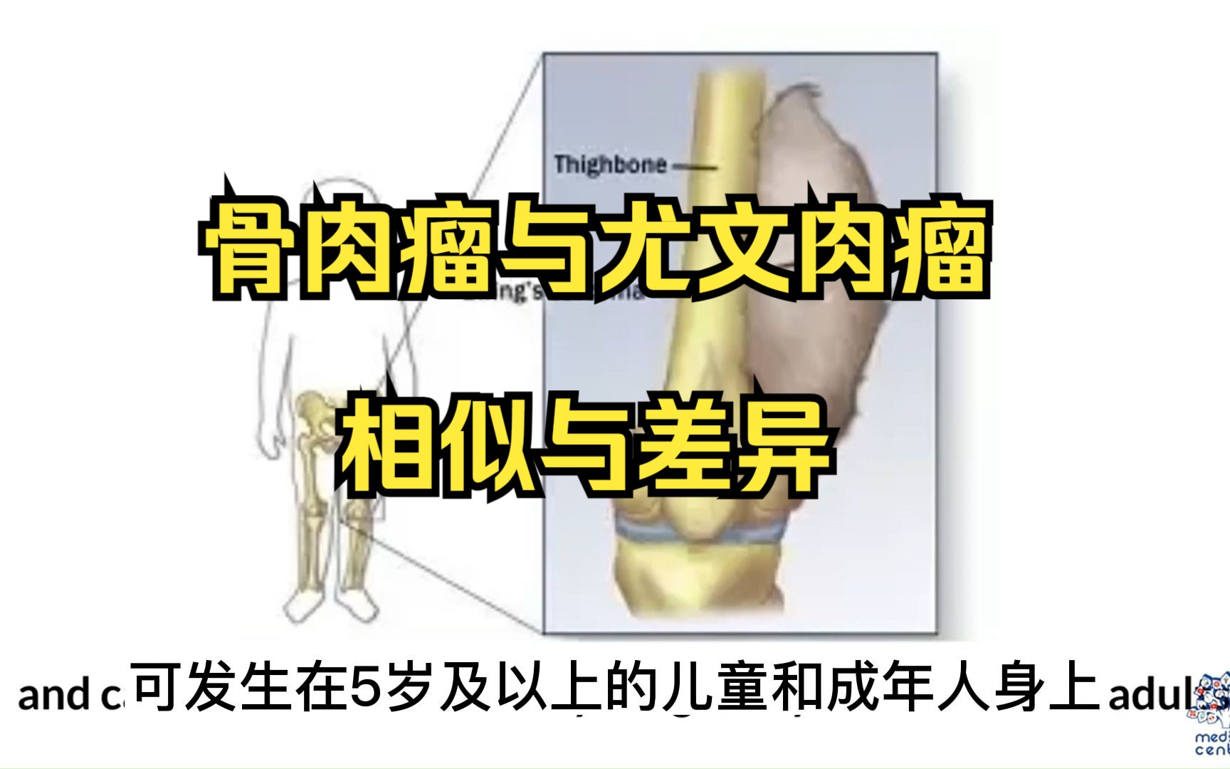 五分钟带你了解骨肉瘤与尤文肉瘤