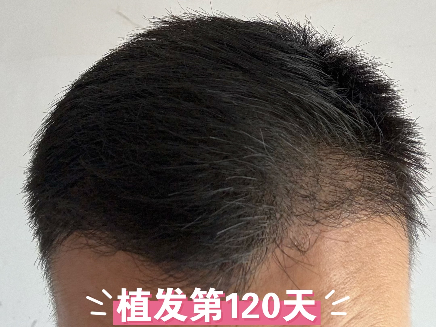 植发丽水(植发失败案例太多)