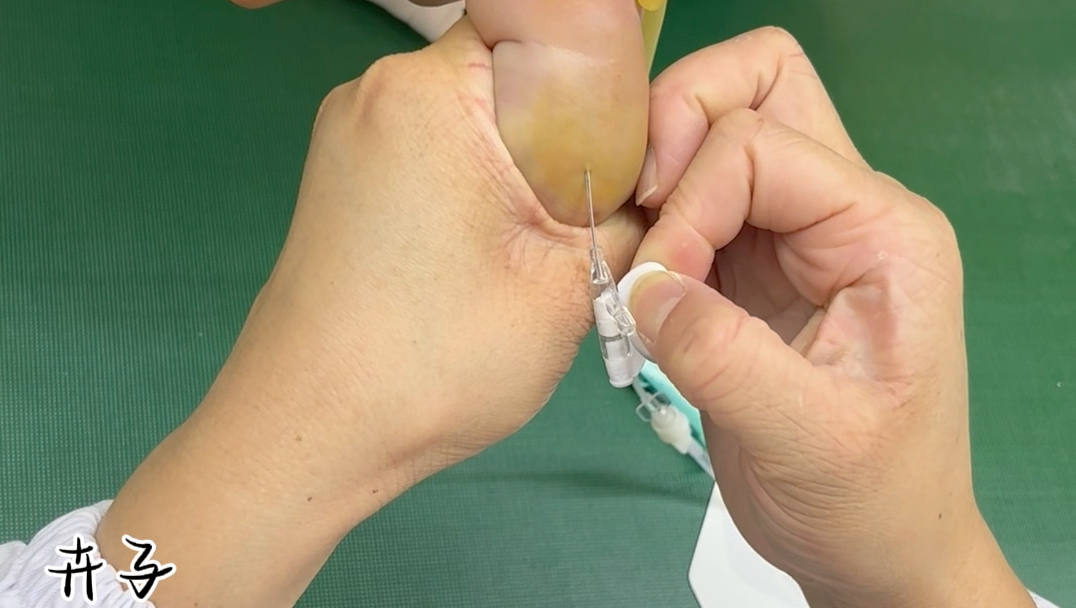 小儿静脉留置针日常分享