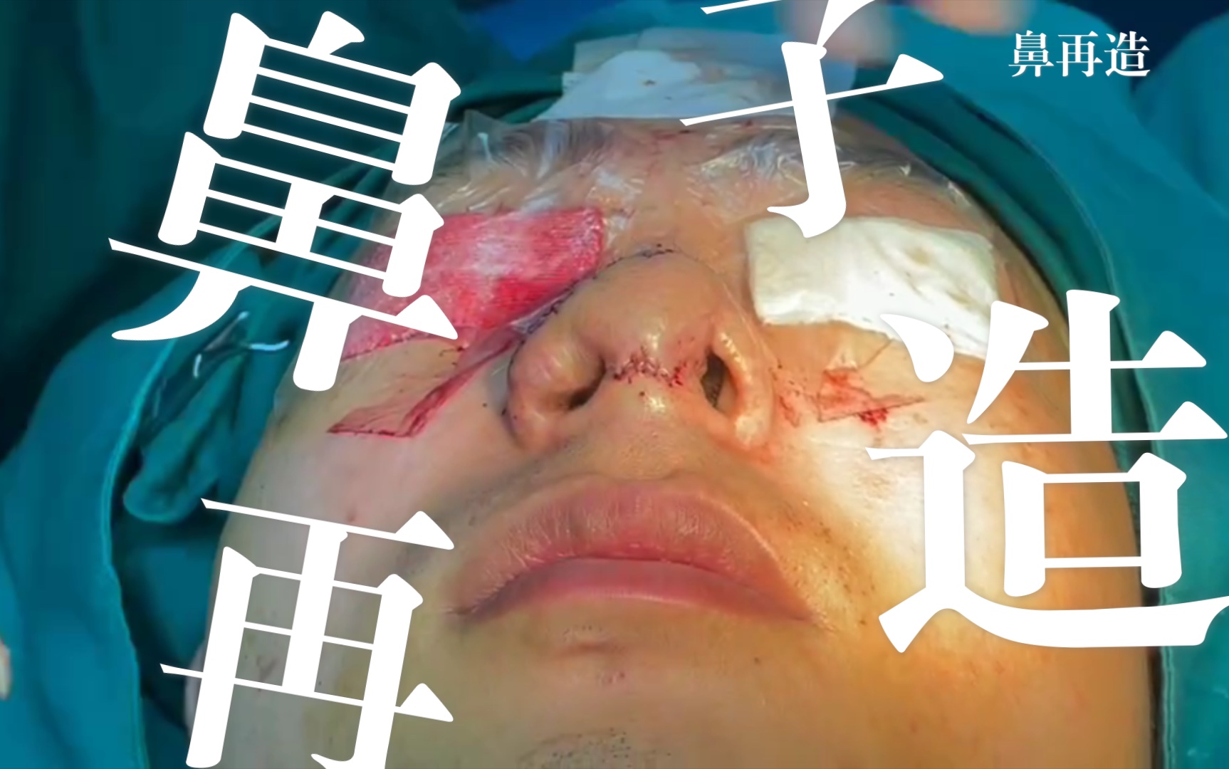 鼻子缺失,需要做补修的同时做形态的矫正,这种鼻型的难度可想而知.