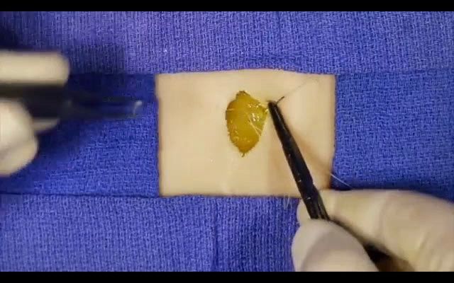 筋膜折叠缝合(fascial plication suture)