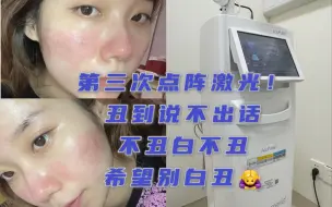 Download Video: 第三次做点阵激光啦 美女丑的睡不着🙇‍♀️