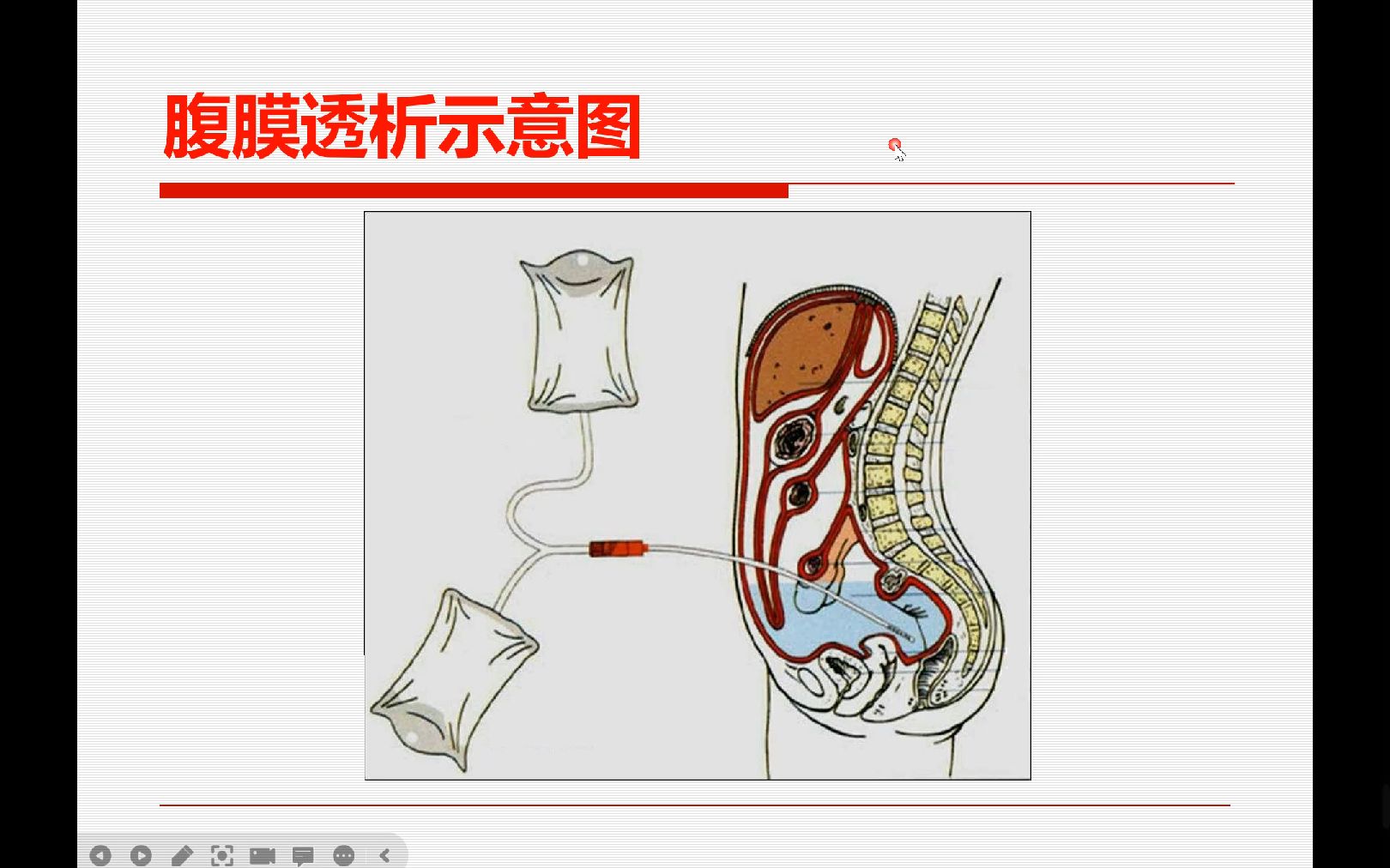 腹膜透析哔哩哔哩bilibili