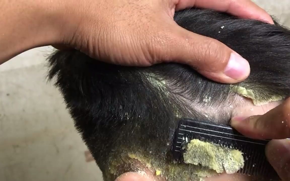 头皮干燥大片头皮屑刮伤