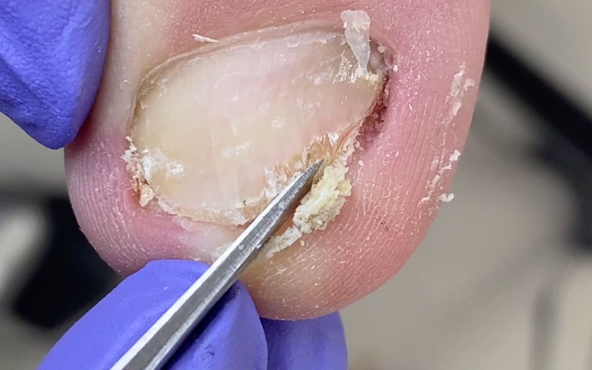 特殊指甲,细菌入侵很有光泽