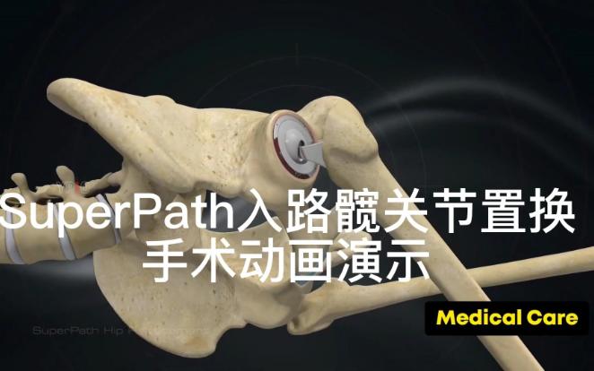 SuperPath入路髋关节置换手术动画演示哔哩哔哩bilibili