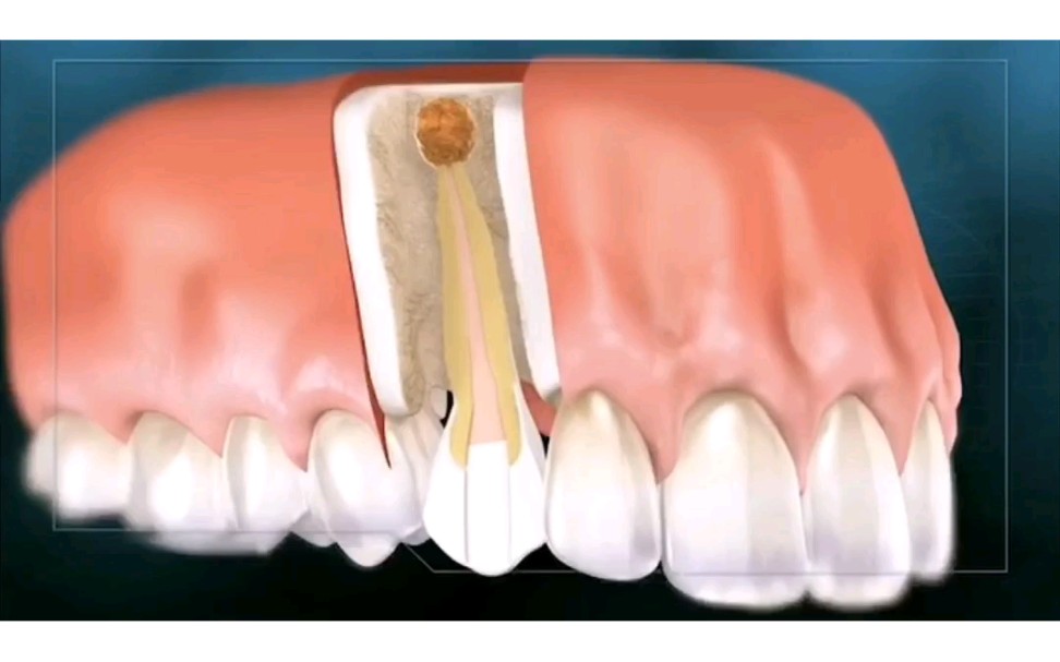 根尖发炎长了囊肿该怎么办? 如果是比较小的囊肿,一般可以考虑做根管治疗,如果囊肿比较大,考虑手术切除囊肿.哔哩哔哩bilibili