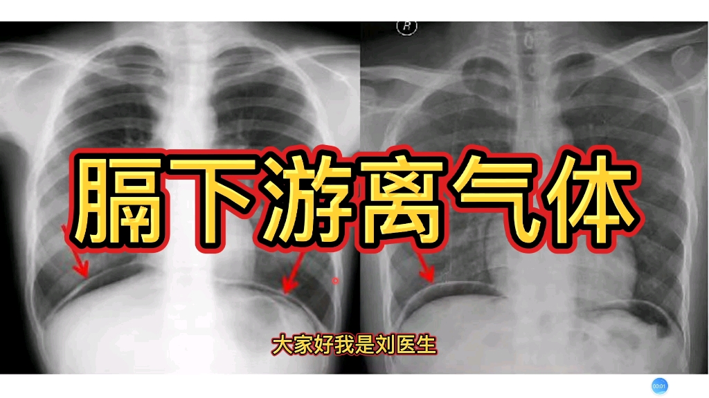 膈下逐瘀汤的功效(膈下逐瘀汤:缓解胸痛,消除瘀血)