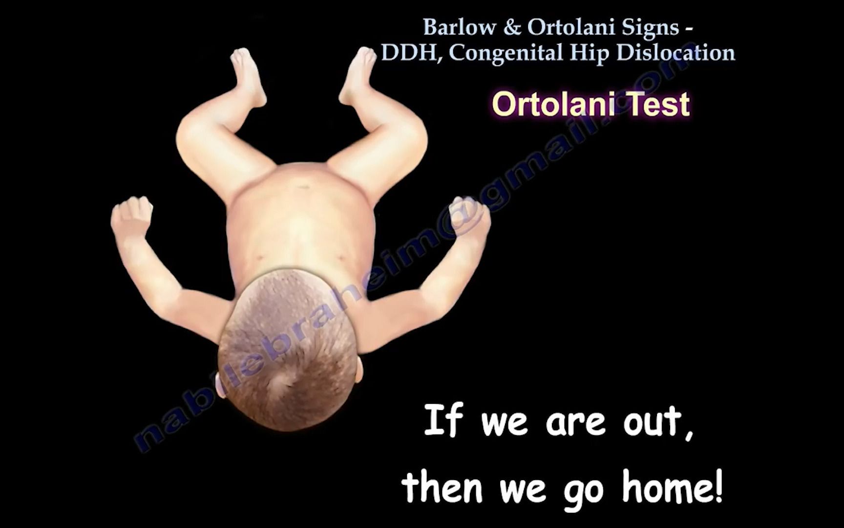 Barlow  Ortolani test Congenital Hip Dislocation Everything You Need To Know哔哩哔哩bilibili