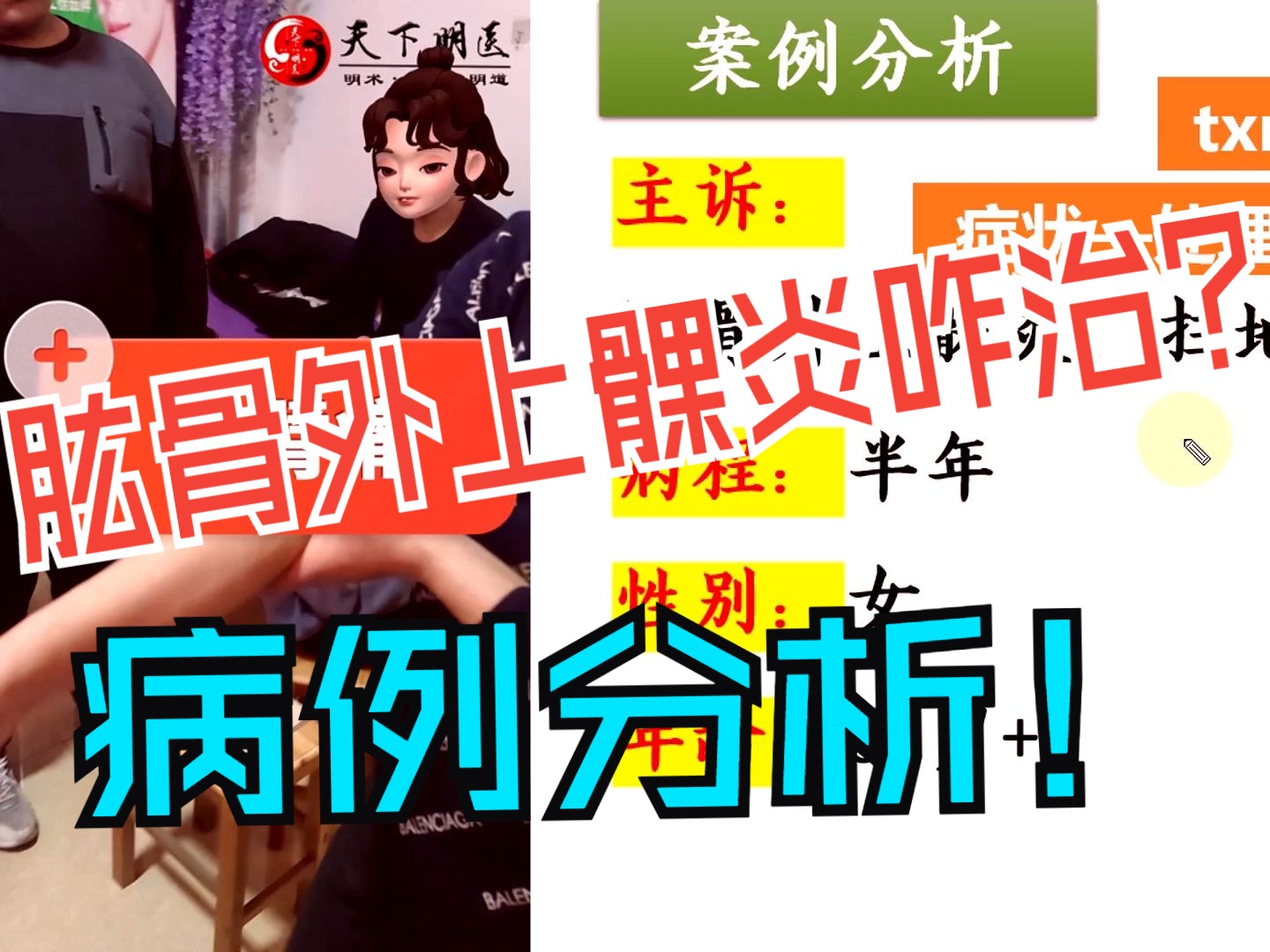 肱骨外上髁炎【案例分析】(肱骨外上髁炎,扫地加重)——使用天下明医