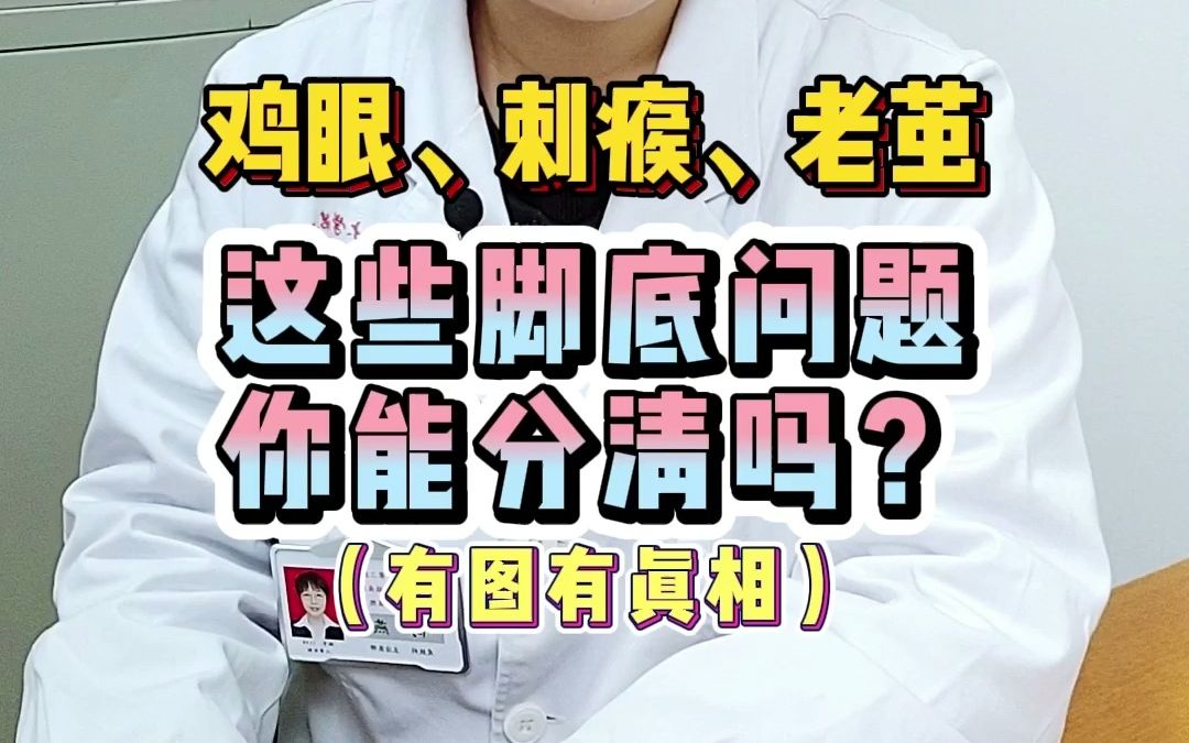 鸡眼、跖疣、胼胝都是脚底的“大宝贝”你能分清吗?|你脚底板有啥?哔哩哔哩bilibili