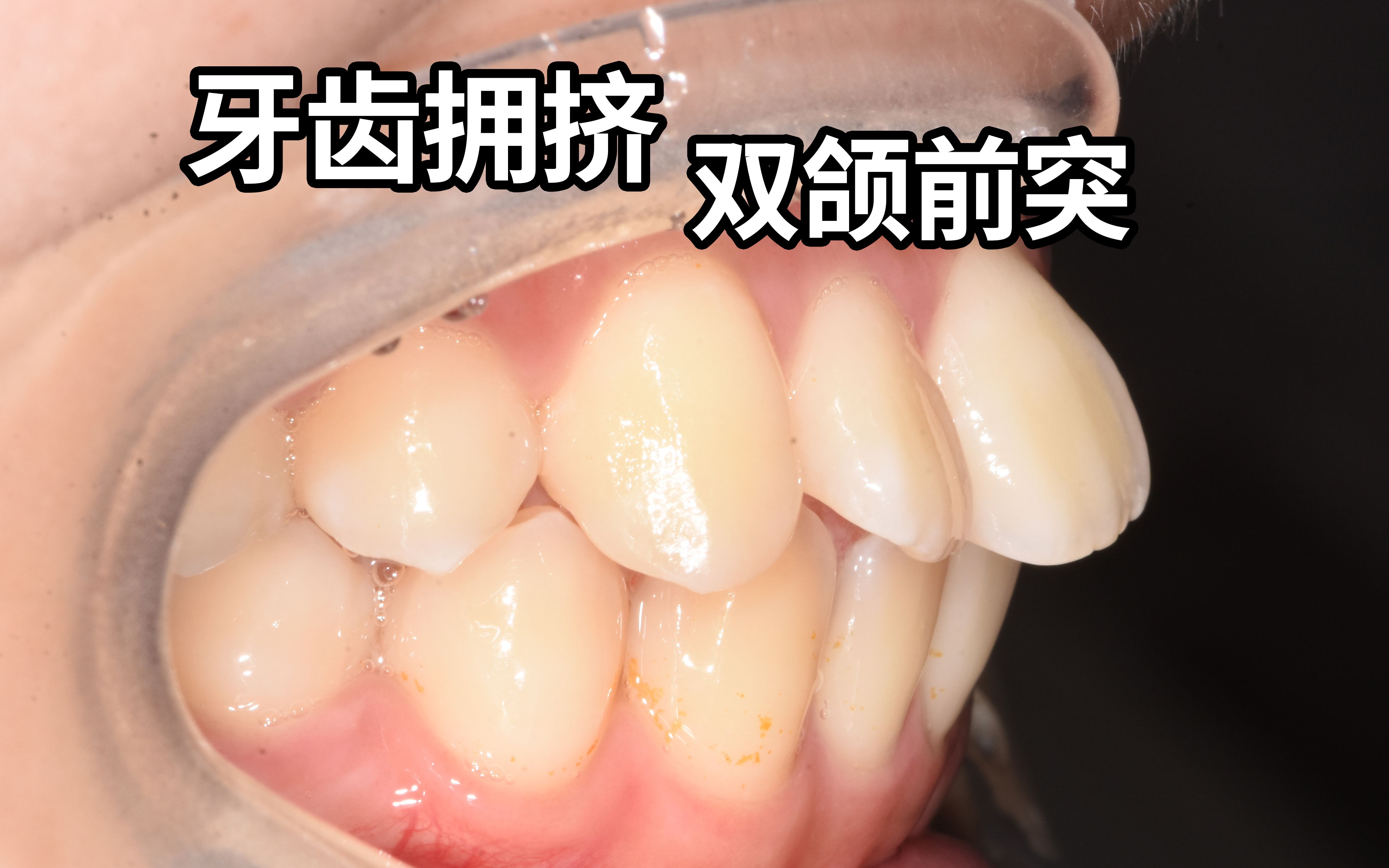 牙齿拥挤,双颌前突,怎样矫正变美?