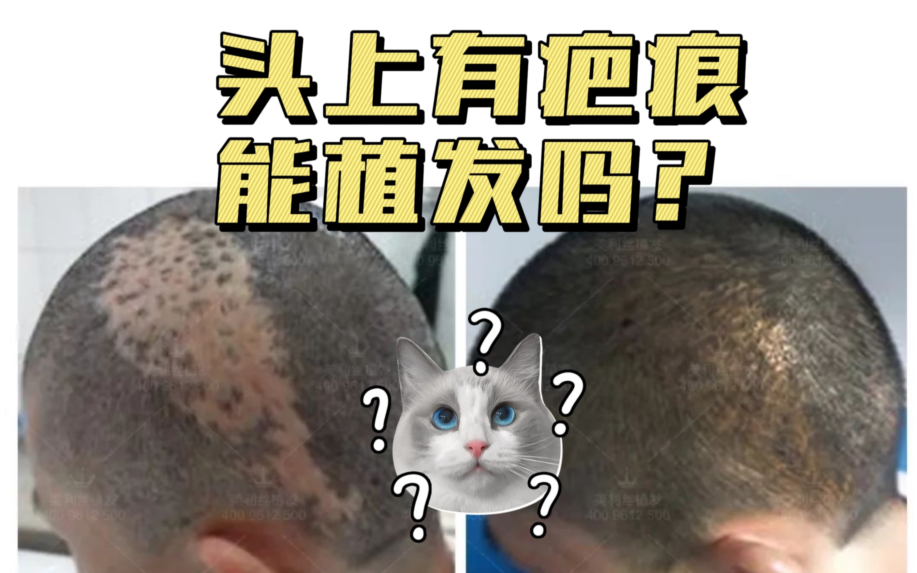 头上有疤痕能植发吗?